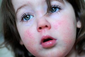 Scarlet fever cases fall but GPs urged to remain vigilant