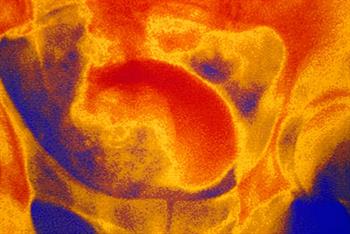 Cialis: first PDE5 inhibitor licensed for benign prostatic hyperplasia