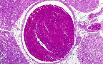 NICE approves apixaban for treatment of DVT and pulmonary embolism