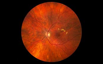 NICE recommends two treatments for diabetic macular oedema