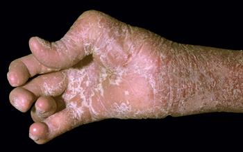 NICE approves further treatment options for psoriatic arthritis