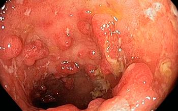 NICE widens approval for TNF inhibitors in inflammatory bowel disease
