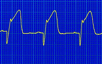 Oral anticoagulant accepted for NHS use after acute coronary syndromes