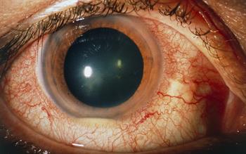 Neoral approved for treatment of sight-threatening uveitis