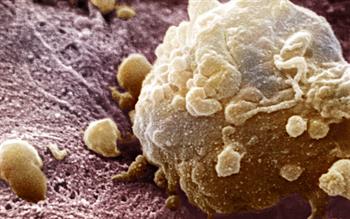 Trametinib, a new protein kinase inhibitor for BRAF V600 positive melanoma