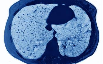 New cystic fibrosis treatment targets underlying cause of the disease