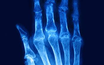 New rheumatoid arthritis treatment approved for NHS use