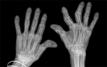 Baricitinib: oral rheumatoid arthritis treatment in new drug class