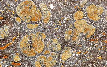 NICE recommends drug to prevent episodes of hepatic encephalopathy