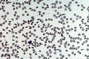 Sickle cell anaemia