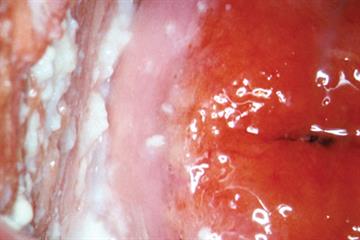 Diagnosing vaginal infections