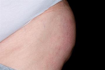 Trochanteric bursitis