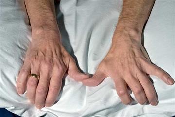 Clinical Review: Motor neurone disease