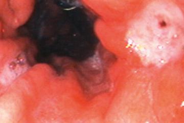 Red flag symptoms - Vomiting in adults