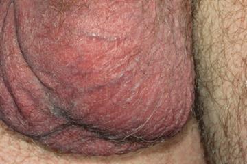 Scrotal pain