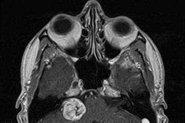 Clinical review: Acoustic neuroma