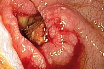 The basics - Coeliac disease