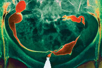 Evidence base: Ovarian cancer