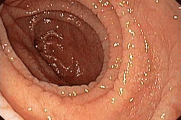 Case study: Undiagnosed coeliac disease