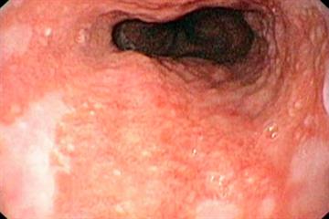 Clinical Review - Gastro-oesophageal reflux disease
