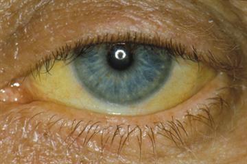 Clinical solutions - Gilbert's syndrome