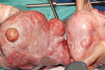 Evidence base: Uterine fibroids