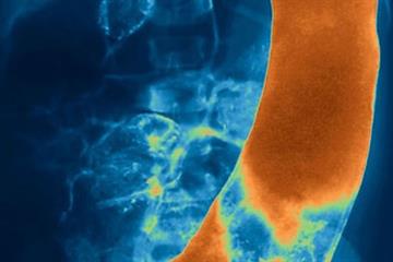 Managing Hirschsprung's disease