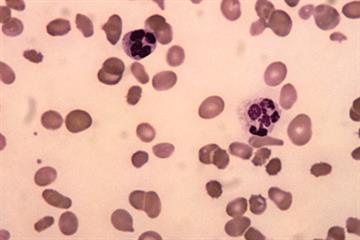 Management of pernicious anaemia