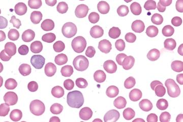 Haematology: Autoimmune haemolytic anaemia