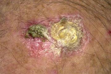 Differential diagnoses: Keratinous conditions