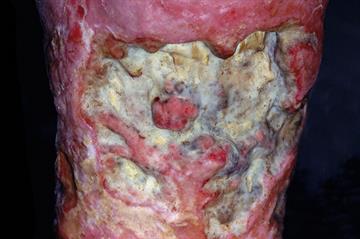 Differential diagnoses: Lower limb ulceration
