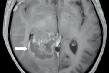 Clinical review: Glioma