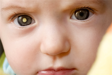 Eye disease - Recognising retinoblastoma