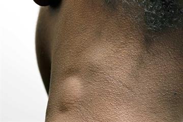 Red flag symptoms: Cervical lymphadenopathy