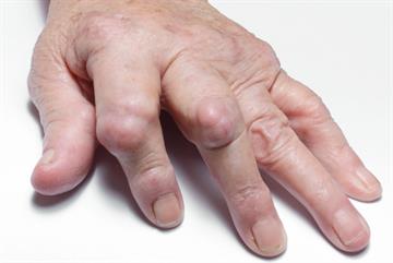 RA diagnosis delayed by reliance on key test, GPs told