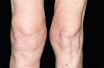 Treatment options in osteoarthritis