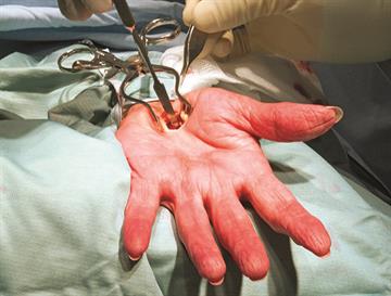 Journals watch: Carpal tunnel syndrome and migraine, divorce and risk of MI