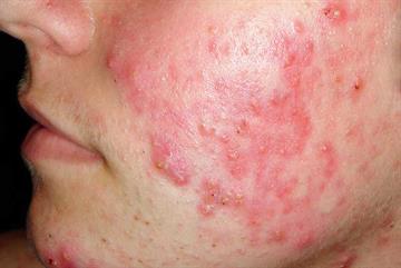 Clinical Review: Acne
