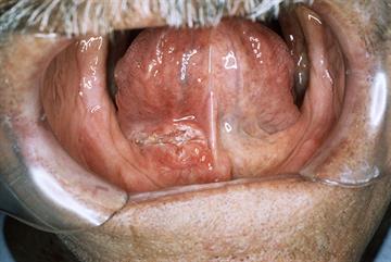 Identifying oral cancer