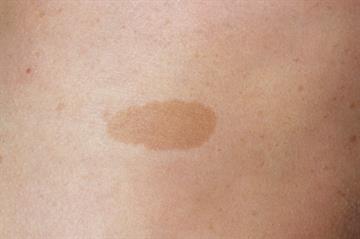 Evidence base: Neurofibromatosis