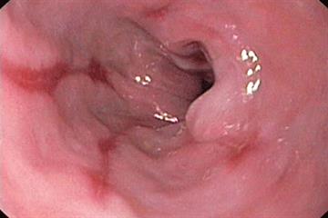 Gastro-oesophageal reflux disease