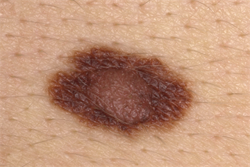 Differential diagnoses - Pigmented skin lesions