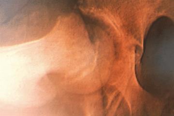 Abnormal gait in children