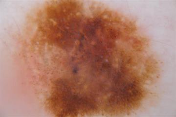 Evidence base: Malignant melanoma