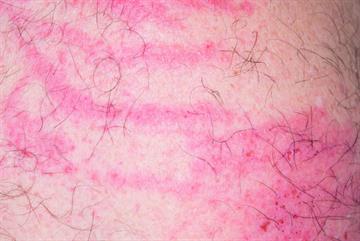 Symptom management: Managing chronic pruritus