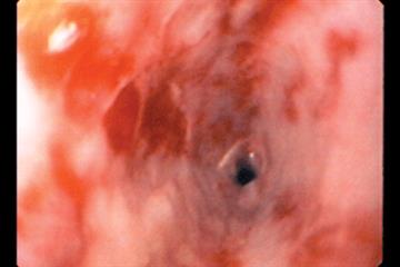The basics - Dyspepsia