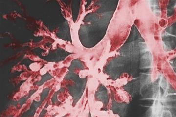 Red Flag Symptoms - Persistent cough