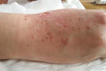 Skin reactions to wound dressings