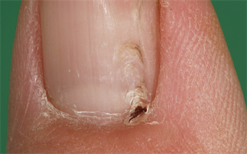 Nail changes - clinical review