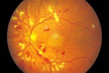 Clinical picture: Hypertensive retinopathy